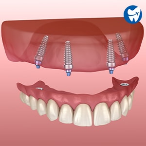 All on 4 Dental Implants