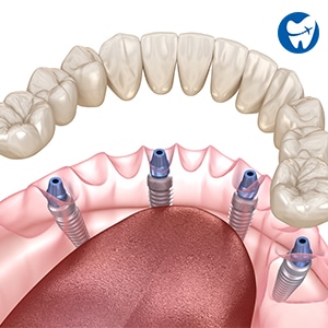 All on 4 Dental Implants