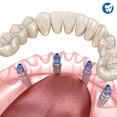 All on 4 dental implants