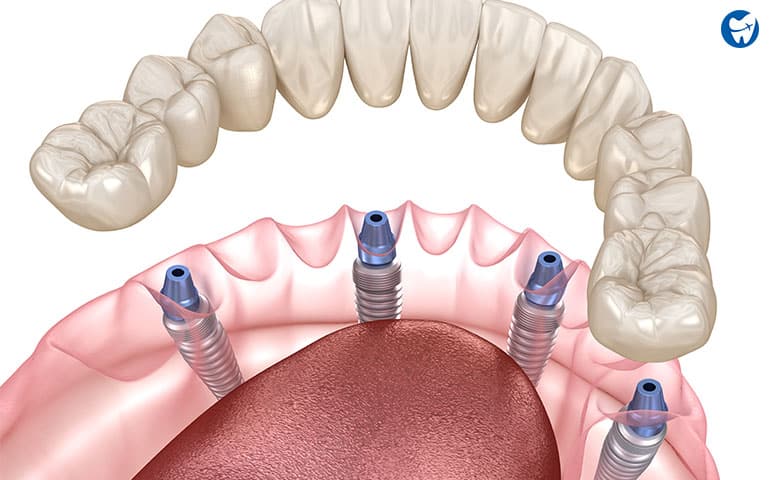 Implantes dentales all on four