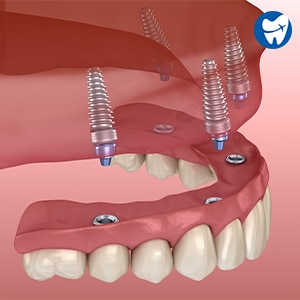 All on Four Dental Implants