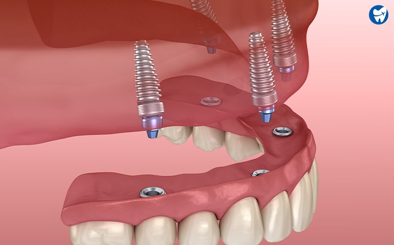 All on 4 Dental Implants