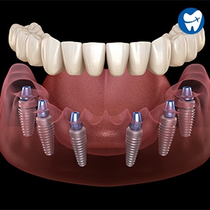 All on 6 implant in Chandigarh