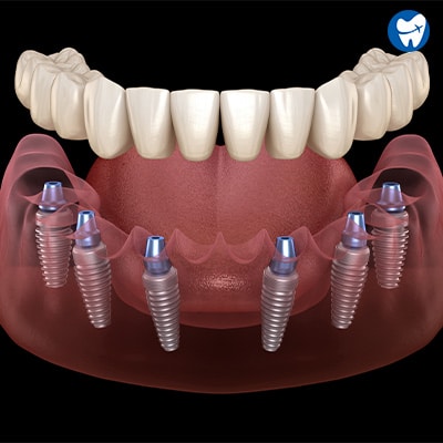 All on 6 dental implants