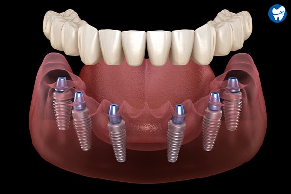 All on 6 Dental Implants