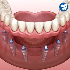 All on Six Dental Implants