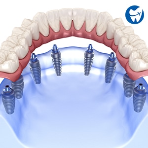 All on 8 Dental Implants