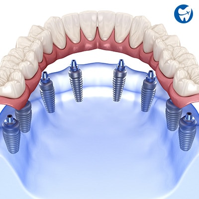 All on 8 Implants