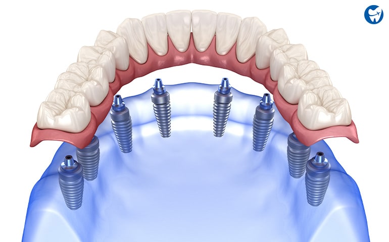 Full Mouth Implants