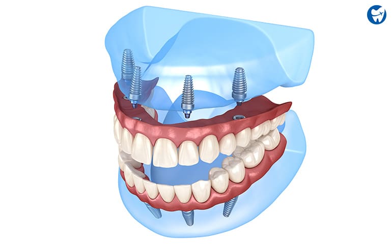 All on 4 Dental Implants