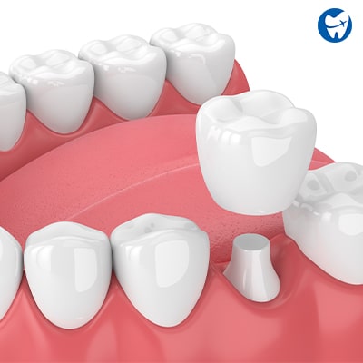 Ceramic Dental Crown