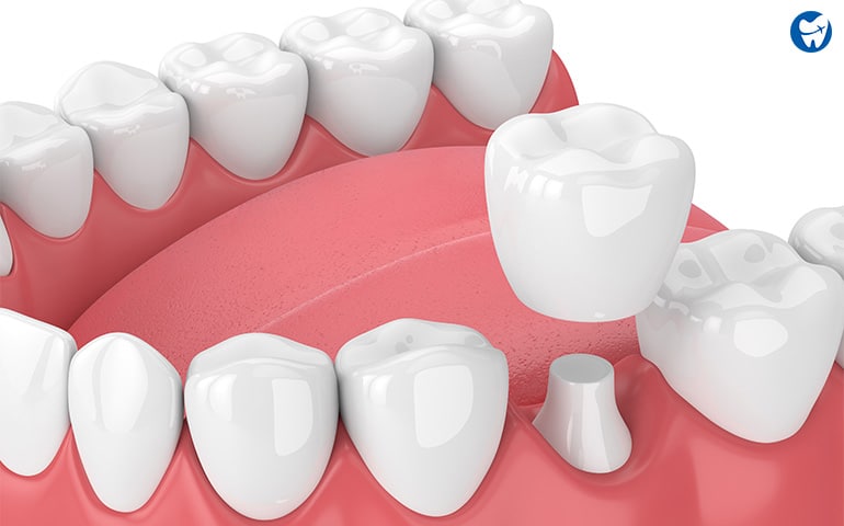 Ceramic dental crown