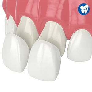 Composite Veneers