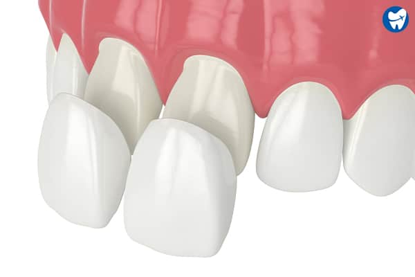 Dental veneers in Indonesia