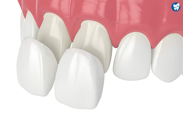 Composite Veneers in Mexico