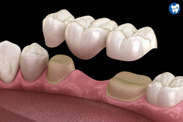 Dental Bridges in Mexico