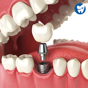 Single dental implant in Albania