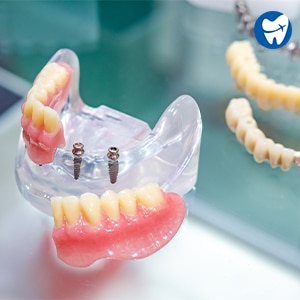 Mini Dental Implants