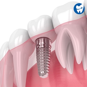 Dental Implant