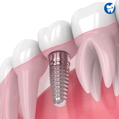 Dental Implants in Medellin, Colombia