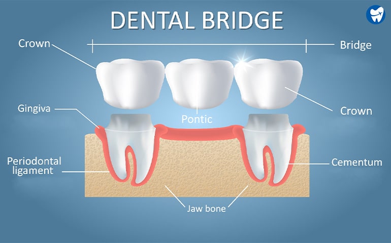 Dental Bridge