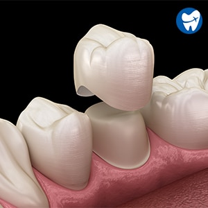 Dental Crowns