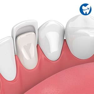 Dental veneers