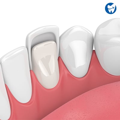 Dental veneers