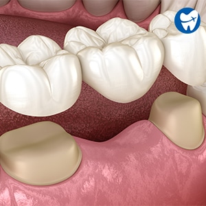 Dental Bridge in Albania