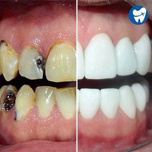 Full mouth reconstruction in Mexico