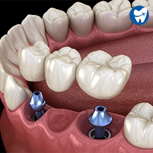 Implant Supported Bridge