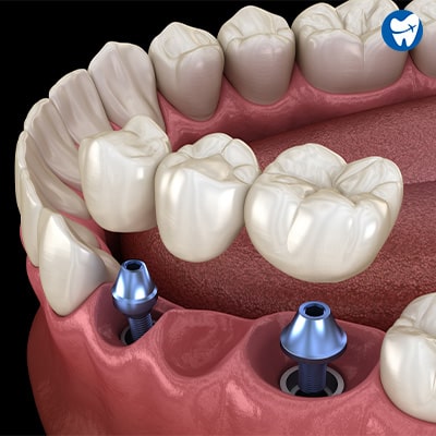 Dental bridge