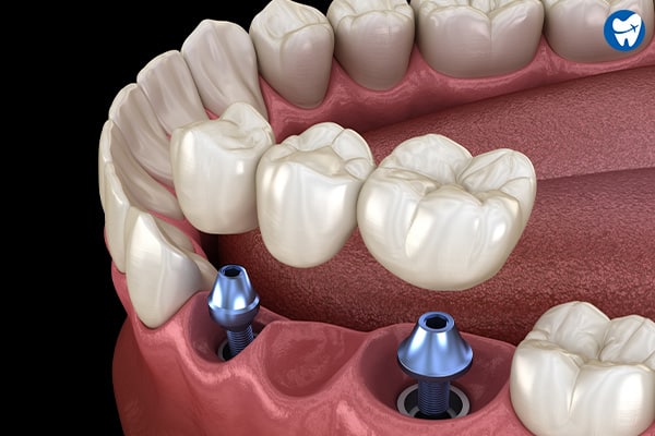 Implant-Supported Bridge in Mexico