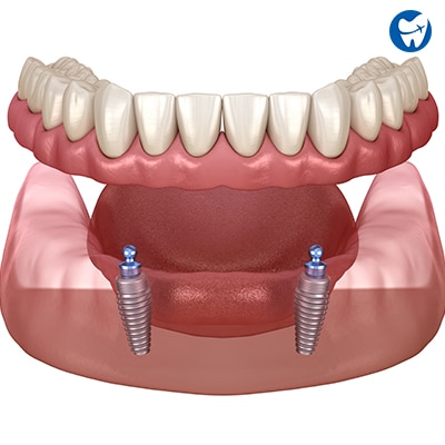 Snap-on Dentures in Costa Rica