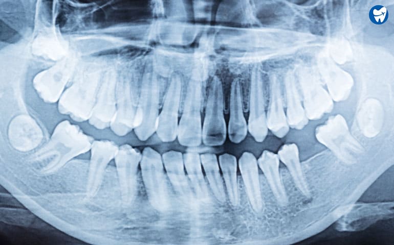 Full mouth xray