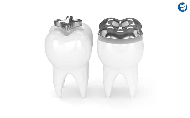 Partial Dental Crowns