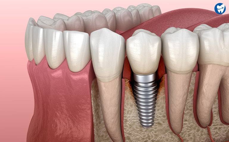 Peri-implantitis