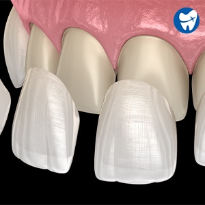 Porcelain Veneers