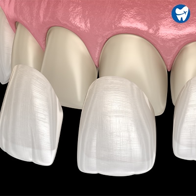 Dental Veneers