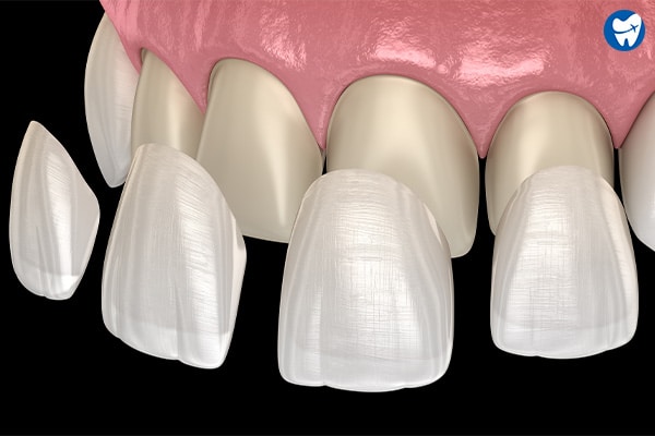 Porcelain veneers