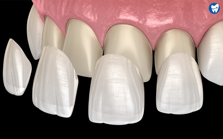 Porcelain Veneers in Mexico