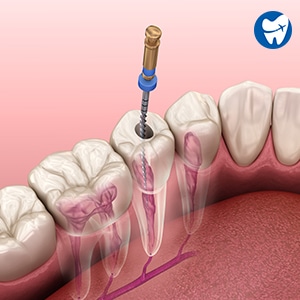 Root canal treatment in Albania