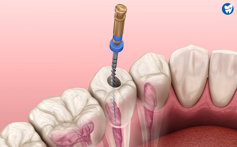 Root canal treatment