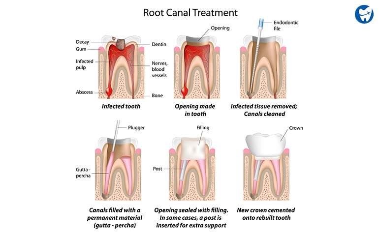 Root Canal Procedure