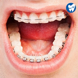 Braces in Barranquilla