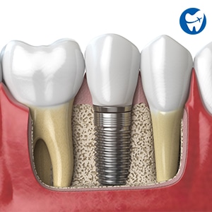 Dental Implants in Bangkok