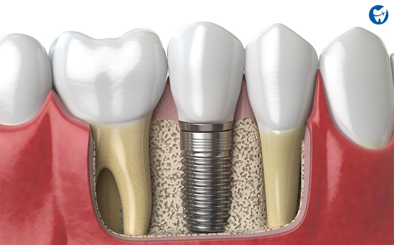 Dental implant