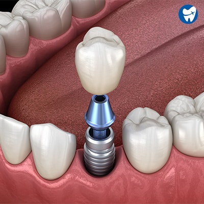 Single dental implant