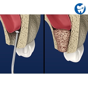 Sinus Lift & Bone Grafts