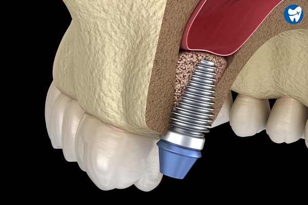 Sinus lift